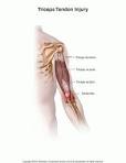 Rotator Cuff TearSurgery Rehabilitation Exercise Program