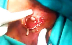 Image result for carbuncle