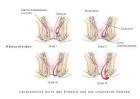 Proktologie Proktologische Beschwerden Hämorrhoiden DR