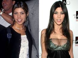 Resultado de imagem para before after surgery