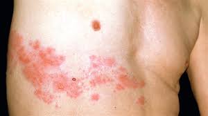 [Image: images?q=tbn:ANd9GcRhBRfXFLpQNrSV7XIjnGF...RJ3t5u-TnA]