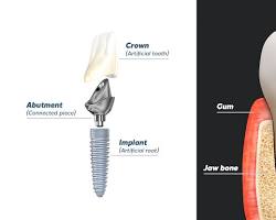 Image of CorticoBasal Implant vs. Traditional Implant