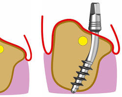 Image of CorticoBasal Implant Placement