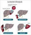 Ablation partielle du foie