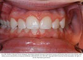 Image result for fluorosis