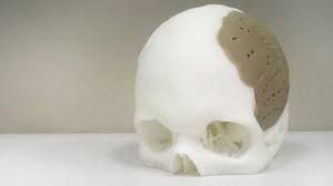 Patient Has 75% Of Skull Replaced With 3D-Printed Implant