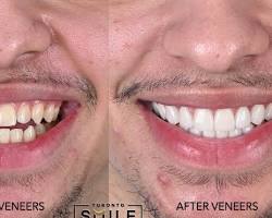 Image of person with discolored teeth before and after receiving veneers