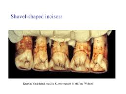 Résultat de recherche d'images pour "shovel shaped incisors"