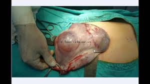 Znalezione obrazy dla zapytania Cysta