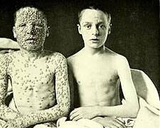 Image of smallpox symptoms historical