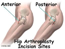 Image result for hip replacement incision site