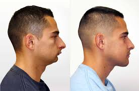 Image result for jaw surgery