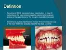 Pseudo class malocclusion