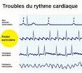 Flutter cardiaque