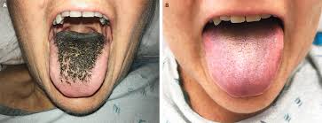 Black Hairy Tongue | New England Journal of Medicine