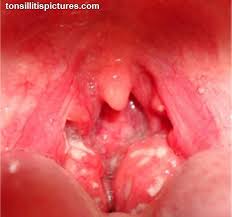 Image result for tonsil stones