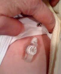 Resultado de imagem para SONDA DE GASTROSTOMIA