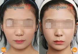 Kết quả hình ảnh cho gọt cằm vline