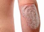 Learn about plaque psoriasis, guttate psoriasis, inverse psoriasis