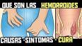 Video de videos de hemorroides