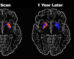 Image of Parkinson's disease brain