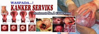 Hasil gambar untuk kanker serviks