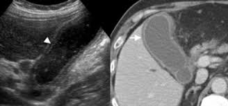 Imagini pentru gallbladder wall layers