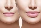 PermaLip Lip Implants Clinic Harley Street London