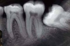 Wisdom tooth 