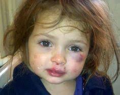Image result for IMÁGENES SORPRENDENTE DE NIÑOS MALTRATADO
