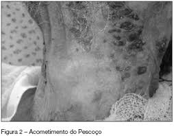 Resultado de imagem para sinais clinicos da síndrome de stevens johnson
