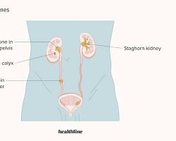 Image of Kidney Stones