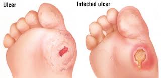 Image result for foot ulcer diabetes