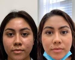microneedling with prp before and after results faces, AI generated