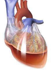 Picture of cardiac tamponade