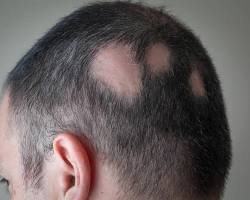 صورة Alopecia areata