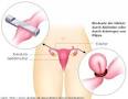 Sterilisation der Frau - Gesundheitsportal