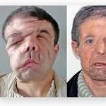  In a medical first, man gets 2nd face transplant