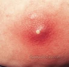 Image result for carbuncle