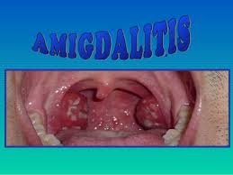 Resultado de imagen para imagenes de LA AMIGDALITIS