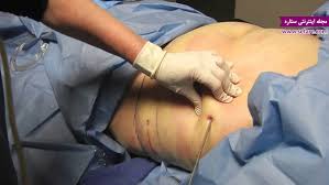 Image result for ‫لیپوساکشن‬‎