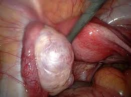 Znalezione obrazy dla zapytania Cysta