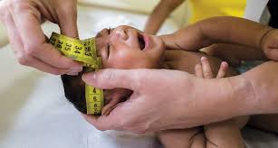 Image result wey dey for images of zika babies