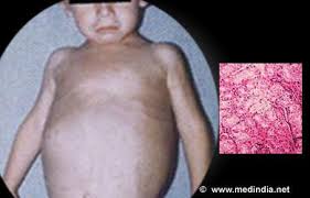 Image result for cori disease