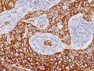 Modern Pathology - Cytokeratin 514-positive breast cancer: true