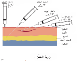 صورة حقنة تحت الجلد