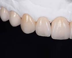 روکش سرامیک دندان
