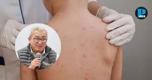 Confirman caso de sarampión en Tetla; autoridades de Tlaxcala se contradicen