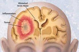 penyakit kanker otak