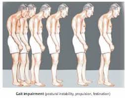 Resultado de imagen para enfermedad de Parkinson juvenil,